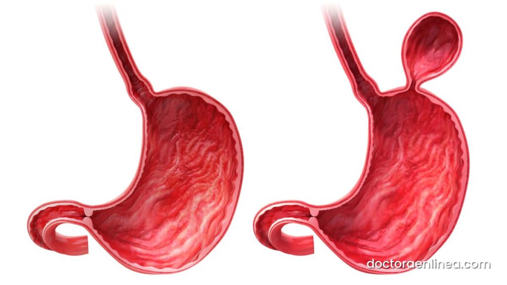 Finalmente, la hernia hiatal es otra de las causas del ardor en el estómago que se debe considerar. 